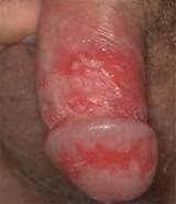 a Ã© herpes Herpes labial / baixo herpes