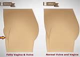 De cima, vÃª-se que a perda de gordura de vulva tem saÃºde tanto e...