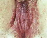 Sangramento vagina levedura infecÃ§Ã£o - arquivo de fotos pornÃ´