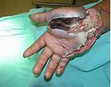 infecÃ§Ã£o apÃ³s surgery.jpg