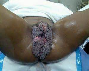 ...-blue-waffle-infection-really-gross-blue-waffle-example-2.jpg