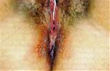 feminino herpes simplex vÃ­rus hsv 2 ao redor da vagina