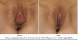 Real antes e depois fotos de Rejuvenescimento Vaginal