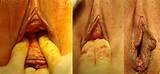 Rejuvenescimento vaginal | Rejuvenescimento labial | Labioplastia...