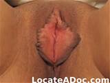 Fotos de rejuvenescimento vaginal de um 43 ano de idade, do sexo feminino, 130 lb, mÃ©dio...