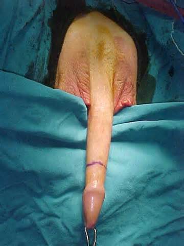 OperaÃ§Ã£o de cirurgia de mudanÃ§a de sexo durante uma cirurgia - imagens/fotos raras...