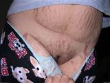 vagina de estrias estrias 1 vagina 225 137 escrota