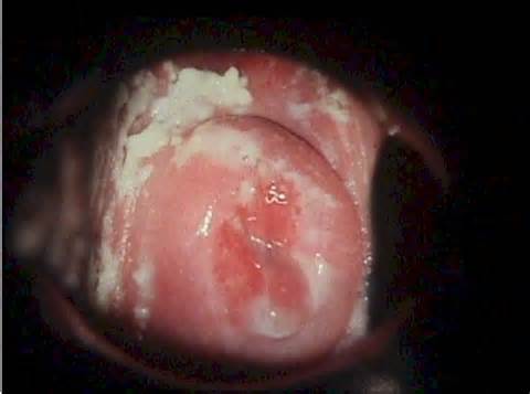 DiagnÃ³stico diferencial da descarga vaginal branca