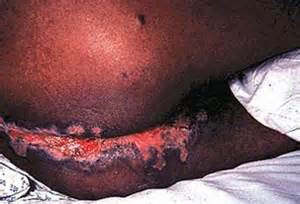 herpes anal do sexo feminino herpes simplex vÃ­rus 2