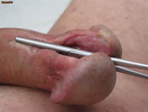 porn613 mutilaÃ§Ã£o de penile - Galeria de imagens de adultos-