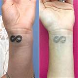 POPSUGAR gritar: O que acontece quando vocÃª se arrepende de sua tatuagem - beleza...