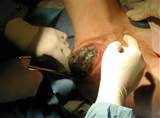 EPISIOTOMIA (ou 